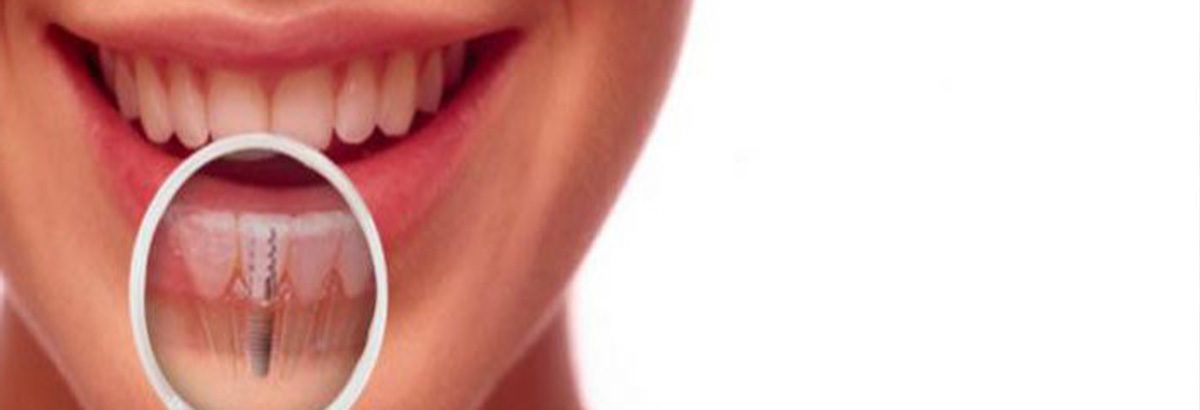 Имплантация — современный метод восстановления утраченных зубов.